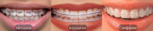 типи брекет-систем
